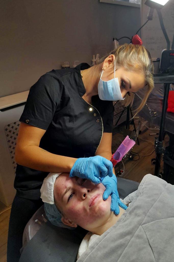 Mezoterapia mikroigłowa